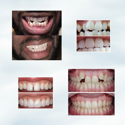 SleepObrace™ ADULTS